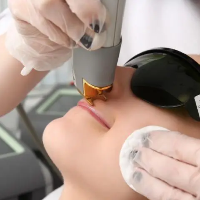 upperlips and body laser hair removal